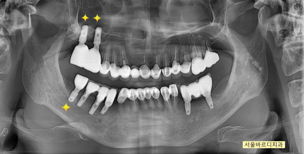 위아래 임플란트 동시에 하여 치료기간 단축하기 관련 이미지 9