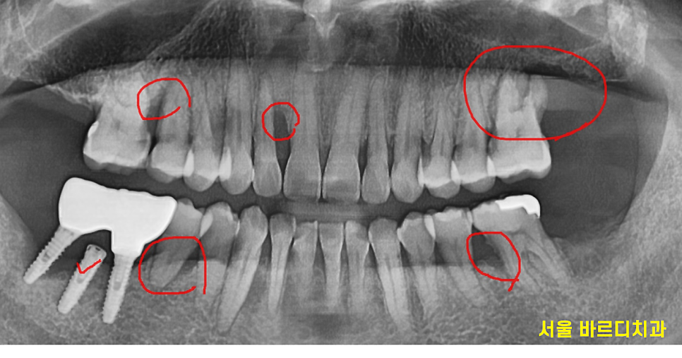 잇몸 고름 냄새 약으로 없앨 수는 없나요? 무시 무시한 치주염 관련 이미지 4
