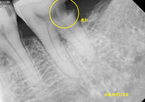 강일동 치과 전남 완도에서 올라오셔서 발치 후 당일 임플란트 완료하였습니다. 관련 이미지 4