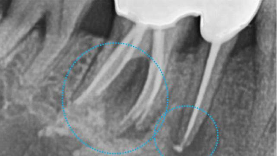 서울바르디치과 상하악 대구치 네비게이션 임플란트 치료증례 #4 관련 이미지 4