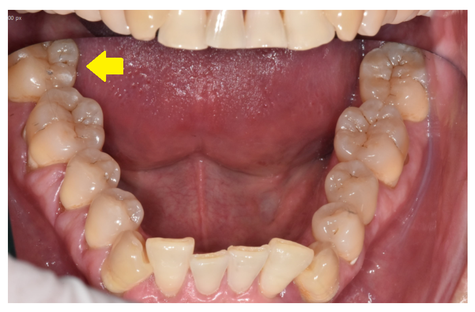 덕풍동 치과 잇몸 욱신 욱신 원인 찾아 임플란트 수술하였습니다. 관련 이미지 2