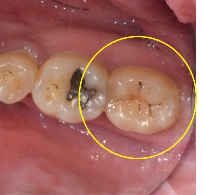 치아에 생긴 하얀 얼룩, 왜 생기나요? 초기 충치일 수 있습니다. 관련 이미지 3