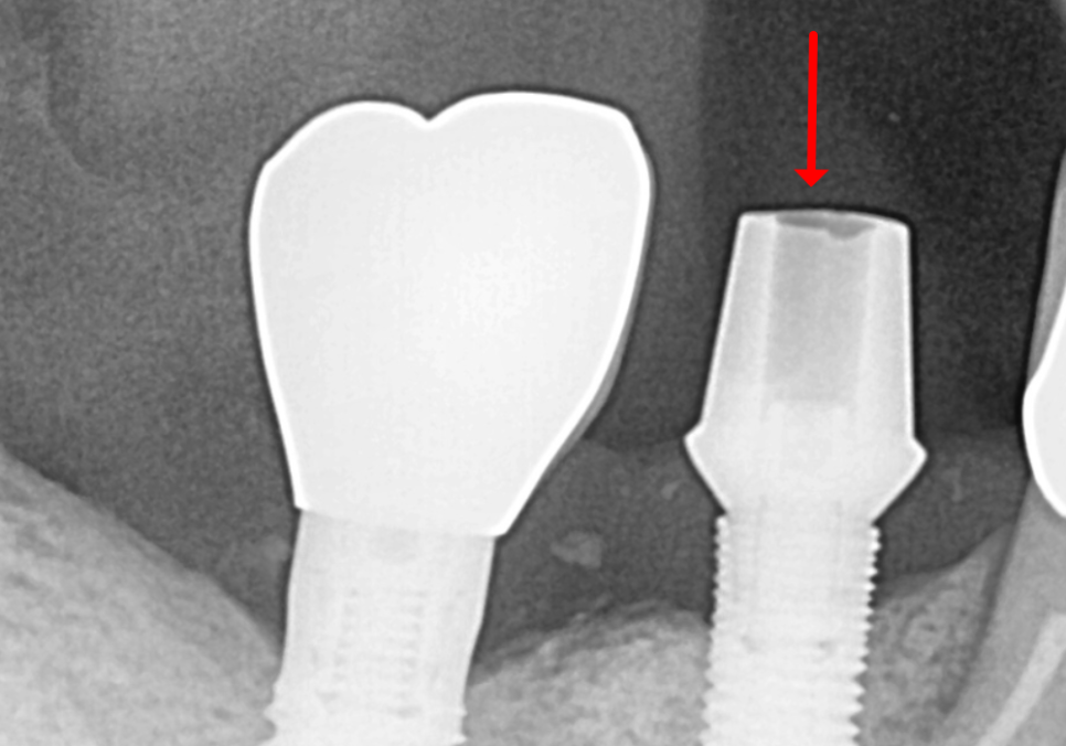 고덕 치과, 임플란트가 흔들려요. 뽑아야 할까 봐 고민이라면? 이렇게 해결합니다. 관련 이미지 10
