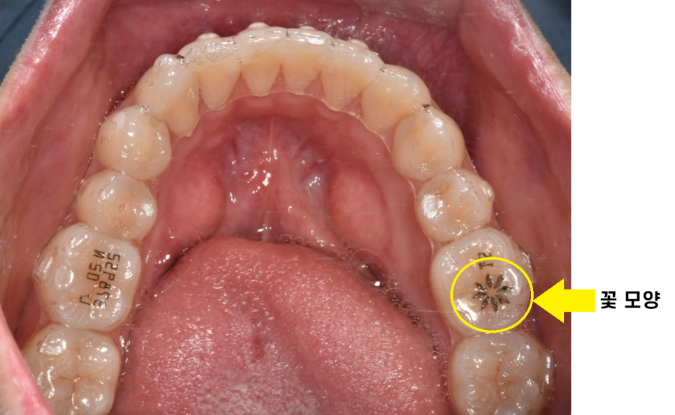 투명교정 장치 종류 인비절라인과 시스루테크 어느 것이 좋을까요? 관련 이미지 2