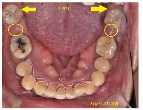 길동 치과 임플란트 뼈이식 후 흡연 상관 있을까? 관련 이미지 4