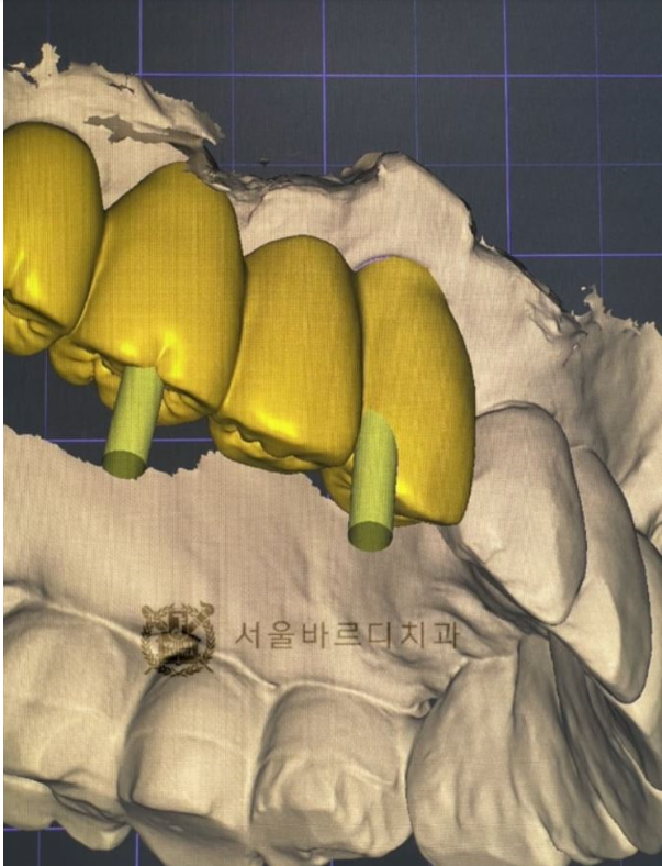 상일동역치과 서울바르디치과 무절개 네비게이션 임플란트 치료증례 #5 관련 이미지 16