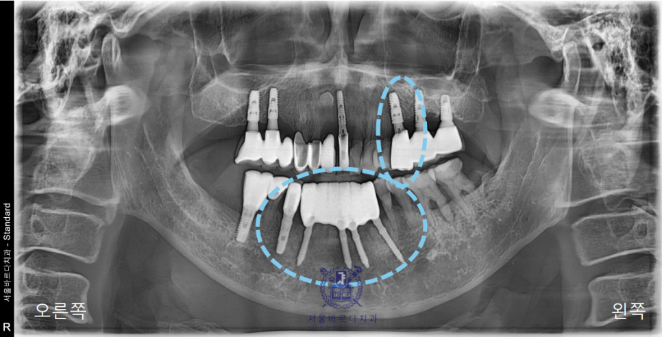 고덕동치과 서울바르디치과 전치부 및 구치부 임플란트 치료증례 #10 관련 이미지 16