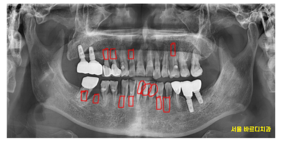 강일동 임플란트 위아래 치아 흔들림과 통증이 있을 때 방법은? 관련 이미지 6