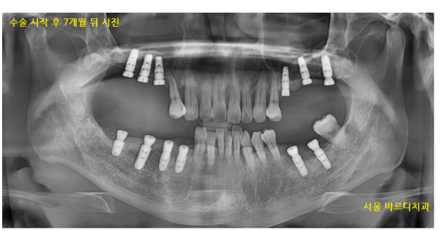 길동 치과 임플란트 뼈이식 후 흡연 상관 있을까? 관련 이미지 9