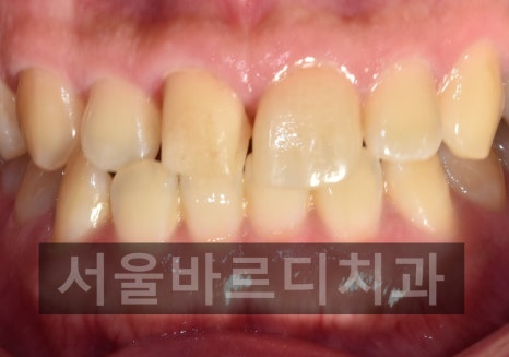 Gangdong-gu laminate failure and detachment: front teeth restored through retreatment image 3