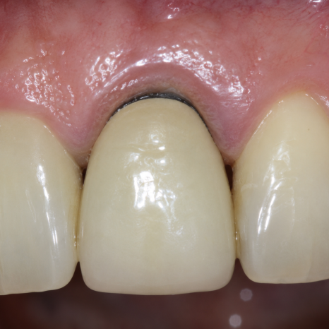 Tooth-Colored Dental Crown Types: PFM and Zirconia (Ziconia) image 4
