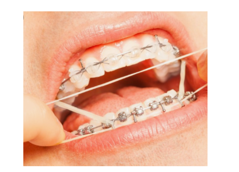 치아 중심선 안맞을 때 걱정스러우신 분들이라면? 관련 이미지 3