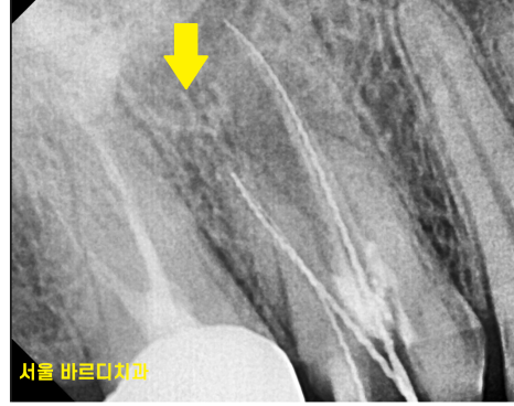 발치 대신 신경치료 뽑기 전 치료는 한번 해봐야하지않을까요? 관련 이미지 6