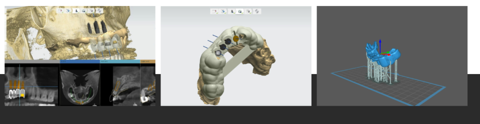 고덕동 임플란트 종류 어떤 회사로 선택해야할지 고민되신다면? 관련 이미지 4