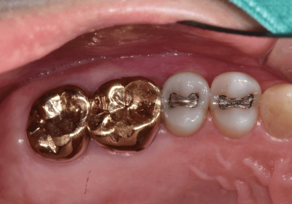 아말감 파절, 조금 깨졌을 뿐인데, 2차 충치로 치아 절반이 깨진 사연 관련 이미지 1