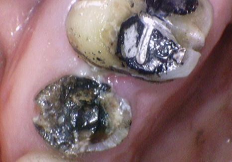 앞니 브릿지 탈락, 씌워둔 게 빠졌어요. 다시 붙일 수 있을까요? 관련 이미지 5