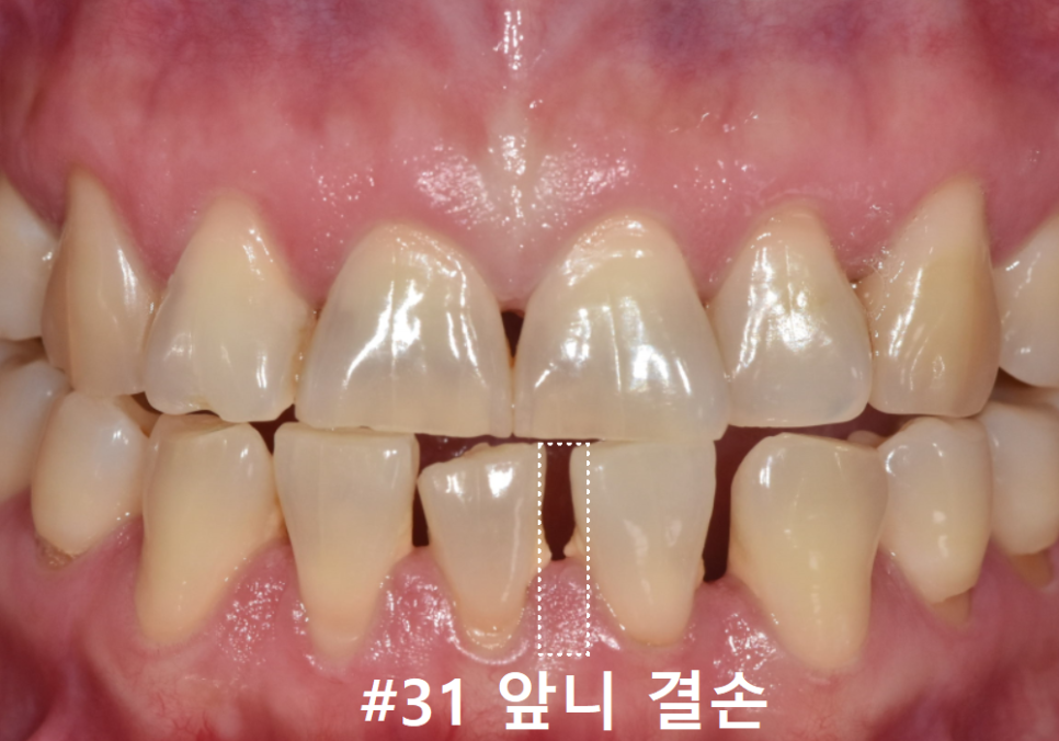 Spaces Between Front Teeth Due to Congenital Missing Teeth: Is Orthodontic Treatment the Only Answer? image 1