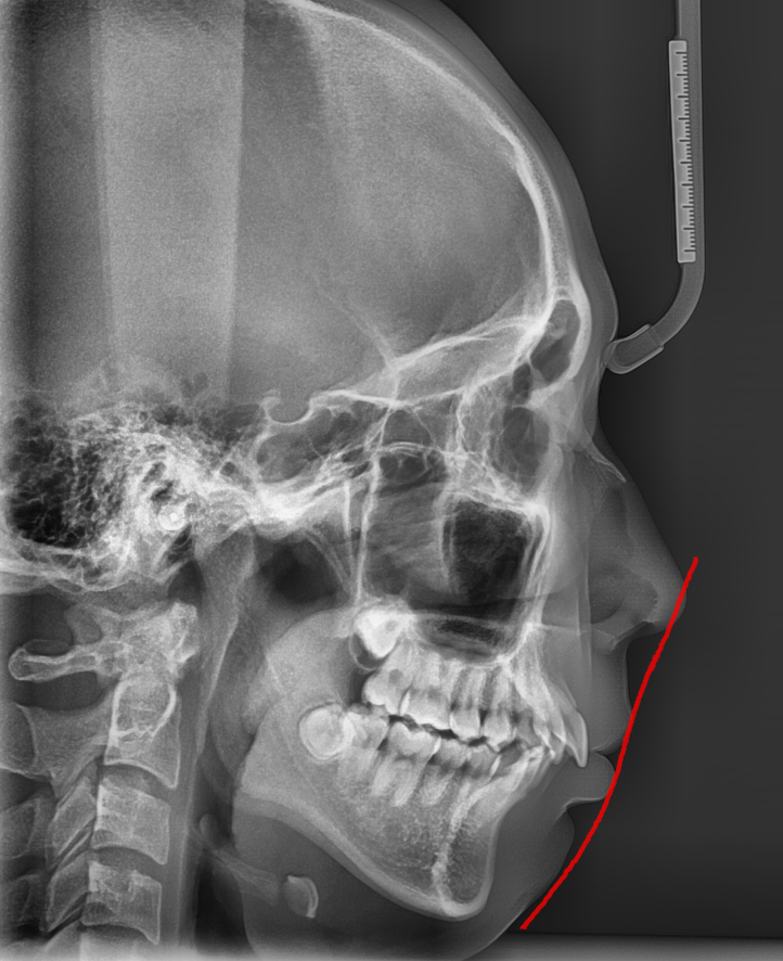 치아 교정 땅콩형 얼굴 되실까 걱정하고 계신다면? 관련 이미지 4