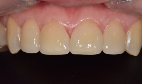 고덕동 치간 이개, 위 앞니 벌어짐, 교정? 라미네이트? 고민이시라면 필독 관련 이미지 11