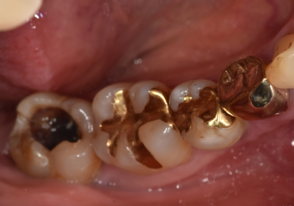 고덕동 스케일링 미루다 앞니 어금니 다 뽑고 임플란트 했습니다. 관련 이미지 7