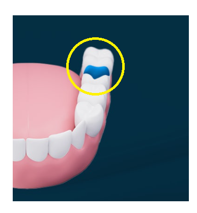 치아교정 턱관절 연관이 있기에 고덕역 치과에서는 이렇게 합니다. 관련 이미지 3