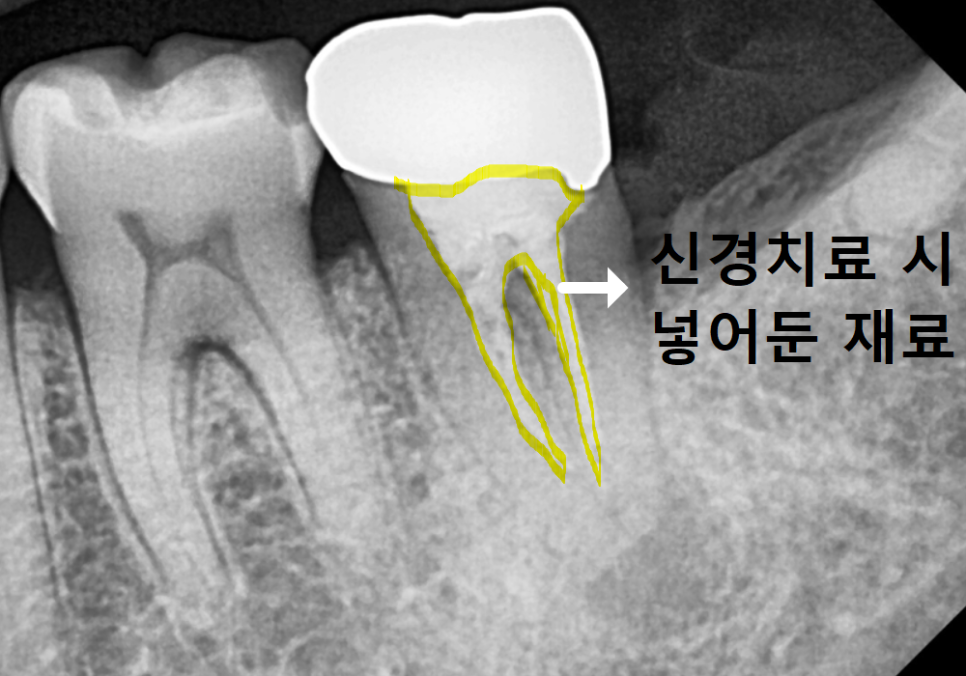 강동구 치아 뿌리 염증, 신경치료 한 치아인데도 아플 수 있나요? 관련 이미지 9