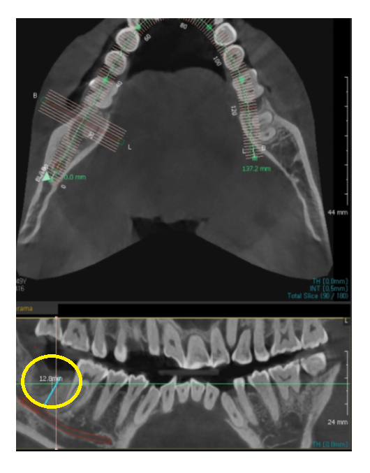 덕풍동 치과 잇몸 욱신 욱신 원인 찾아 임플란트 수술하였습니다. 관련 이미지 7