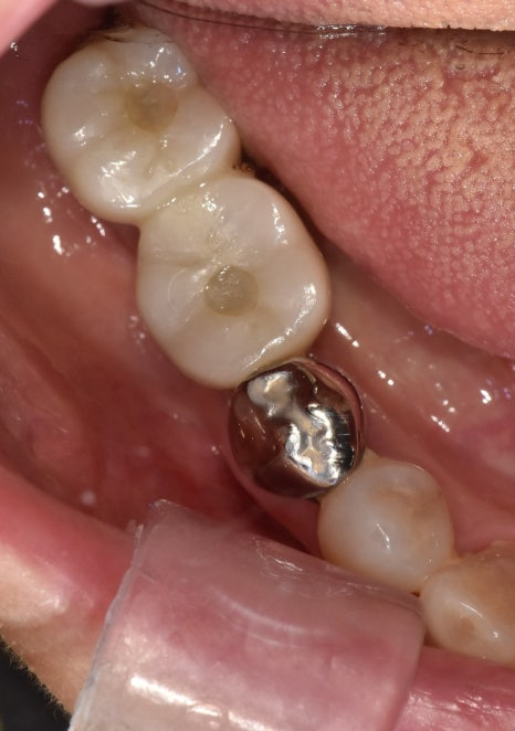 A Case of a 69-Year-Old Who Underwent Immediate Implant Placement After Extraction Due to Tooth Decay in Godeok-dong image 3