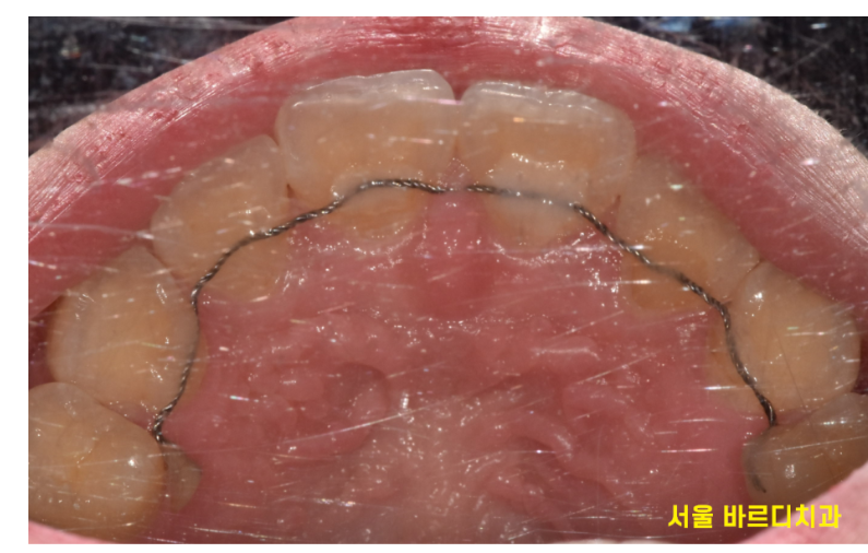 강일동 치아교정 과정 시작부터 마무리까지 알려드려요! 관련 이미지 5