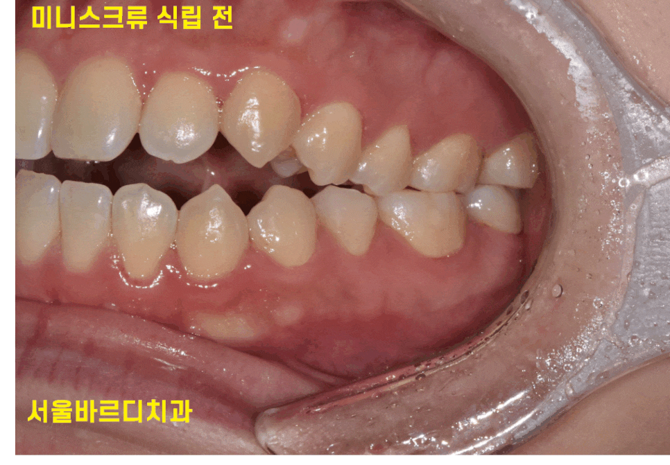 교정중 미니스크류 필수일까? 투명교정도 때로는 필요하다 관련 이미지 1
