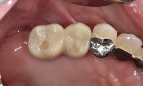 명일동 치과 임플란트 치료 기간 얼마나 걸릴까요??? 관련 이미지 10