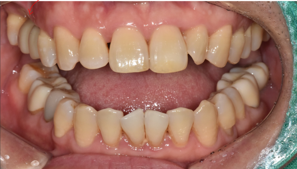 고덕동 치과 잇몸 주저앉음 느낌이 들었다면 늦었을 수도 있습니다. 관련 이미지 12