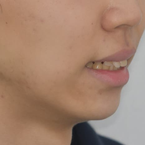 교정한다고 생니를 빼야 하나요? 빼는 경우 안 빼도 되는 경우 관련 이미지 5