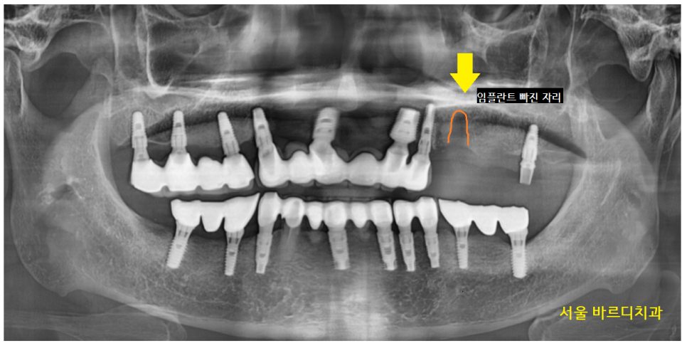 덕풍동 치과 오래된 임플란트 제거 후 재식립하였습니다. 관련 이미지 9