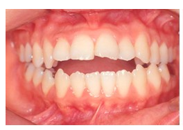 고덕동 교정치과 부정교합은 무엇인가요? 어떨때 치료가 필요한가요? 관련 이미지 4