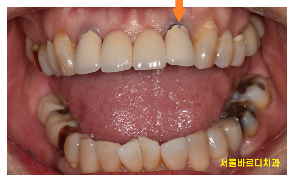 앞니 잇몸 검은색 라인 오래된 pfm 보철 교체하세요!! 관련 이미지 2