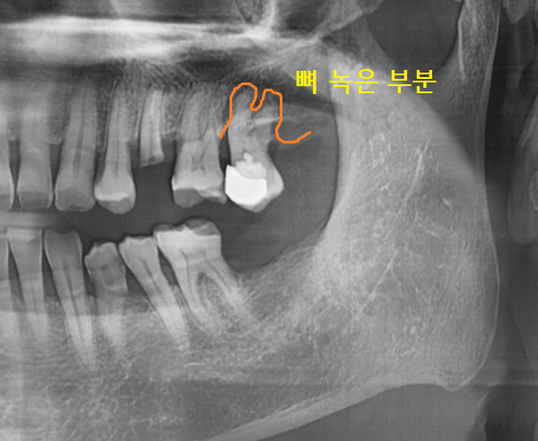 강일동 치과 치아 부러짐 붙일 수 있을까요?? 관련 이미지 8