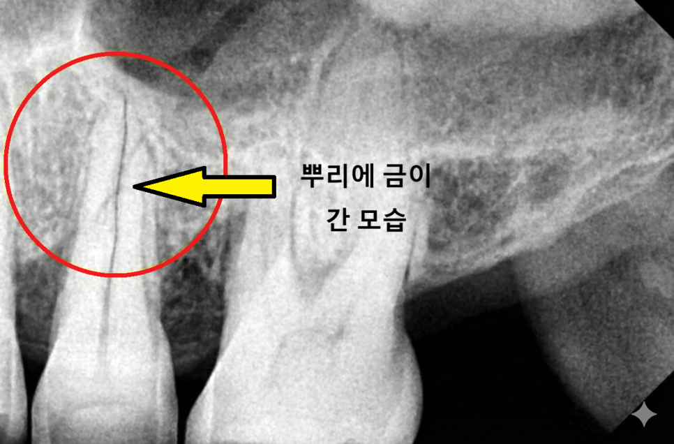 대문니 파절, 앞니에 금이 쩍 갈라졌다면? 딱딱한 음식을 조심해야 하는 이유 관련 이미지 4