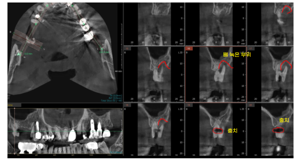 예전에 씌운 이 상악동 거상술 뼈이식 동반하여 임플란트 완료 관련 이미지 4