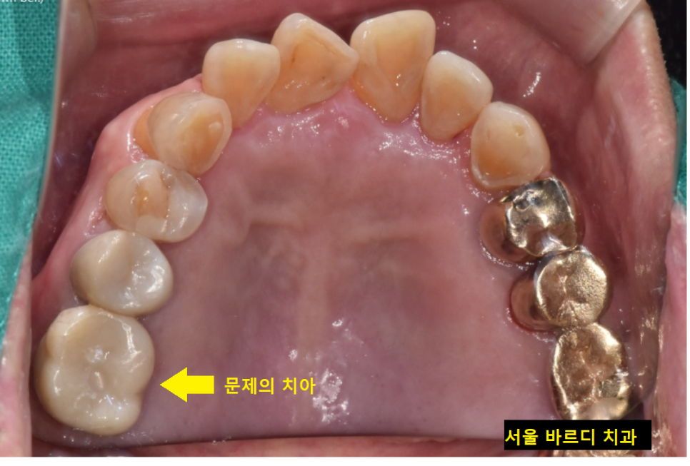 명일역 근처 치과 치아 뿌리 염증이 생겨서 고생하신 사연 관련 이미지 9