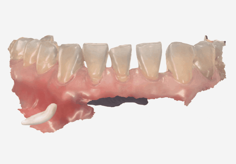 Spaces Between Front Teeth Due to Congenital Missing Teeth: Is Orthodontic Treatment the Only Answer? image 5