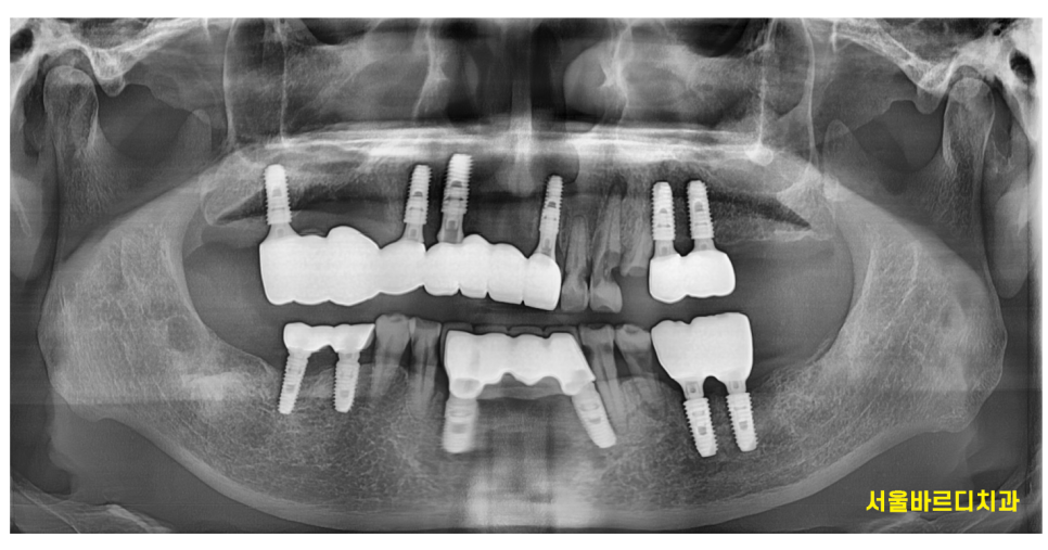 천호동 치과 자연 발치 후 방치된 치아 임플란트 케이스 관련 이미지 13
