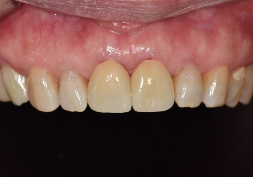 마모된 윗 앞니가 까맣게 변했다면? 방치하면 안 되는 이유 관련 이미지 11