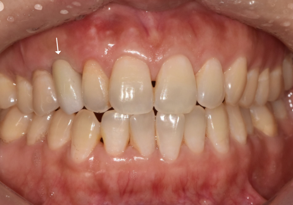 흔들리는 성인 잔존 유치, 50년 만에 송곳니 임플란트 하게 된 사연 관련 이미지 13
