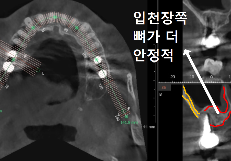 잇몸 고름 눌러보니 푹... 임플란트 주위염 방치했다가 재수술한 사례 관련 이미지 10