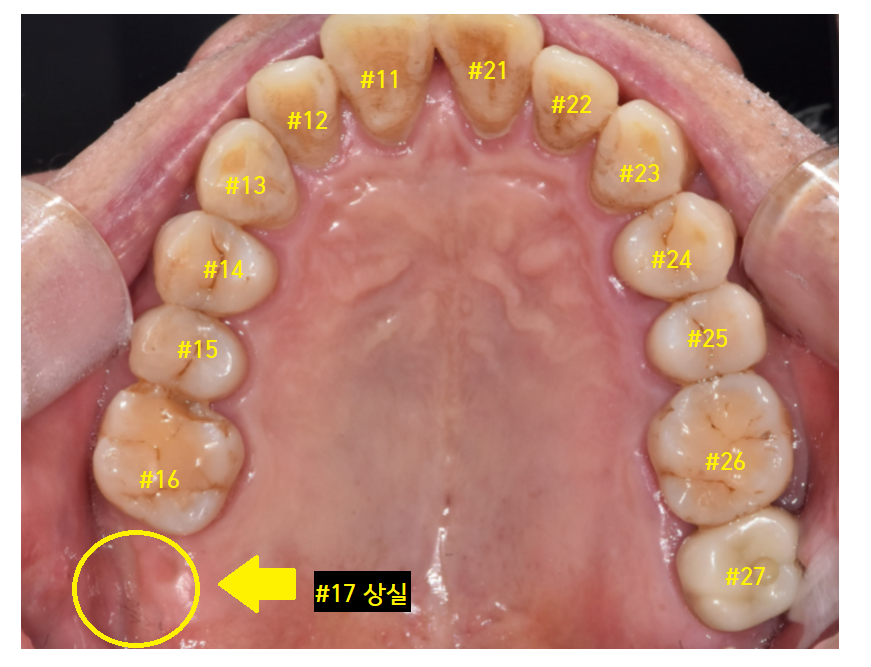 암사동 치과 임플란트 꼭 안 해도 되는 경우 궁금증 해결해 드려요 관련 이미지 4