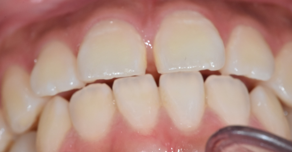 3 Ways to Fix Gaps Between the Front Teeth with Orthodontic Treatment image 6