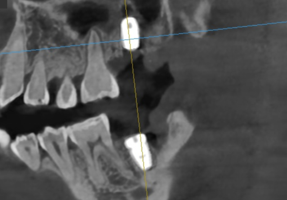 If you lightly brush your backmost molar because the toothbrush can’t reach it, this is what happens. image 15