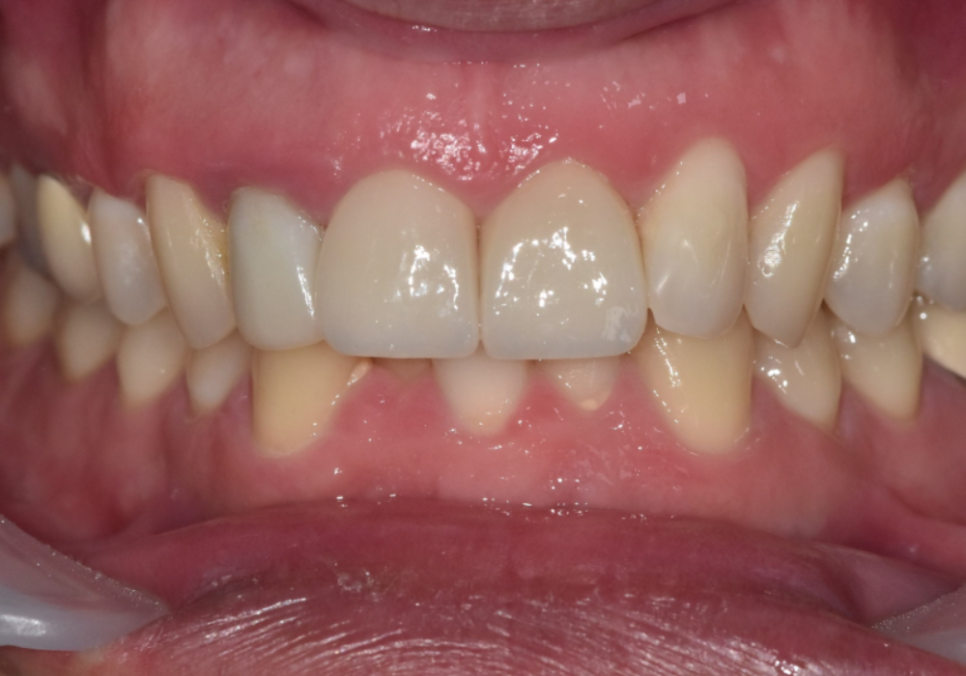 앞니 덧니, 교정은 싫고 시간은 없다면? 라미네이트로 해결한 사례 관련 이미지 12