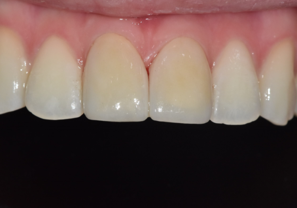 절단교합으로 인한 앞니 레진 깨짐, 교정 없이 해결한 사례 관련 이미지 11